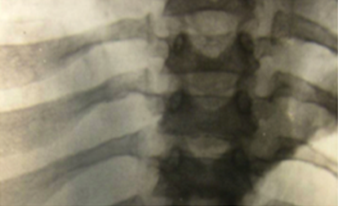 Radiograph-showing-dysostosis-multiplex-manifestations-in-pelvis-and-hips-rounded-iliac-wings-double-contoured-ileal-lateral-walls-